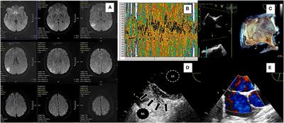 A Narrative and Critical Review of Randomized-Controlled Clinical Trials on Patent Foramen Ovale Closure for Reducing the Risk of Stroke Recurrence